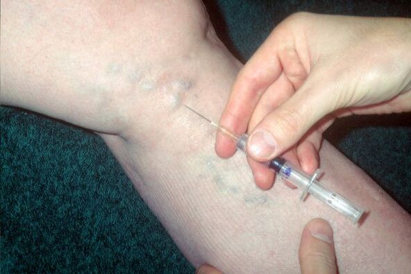 varisli damarlar için skleroterapi