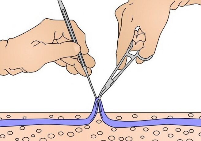 varisli damarlar için damar sıyırma