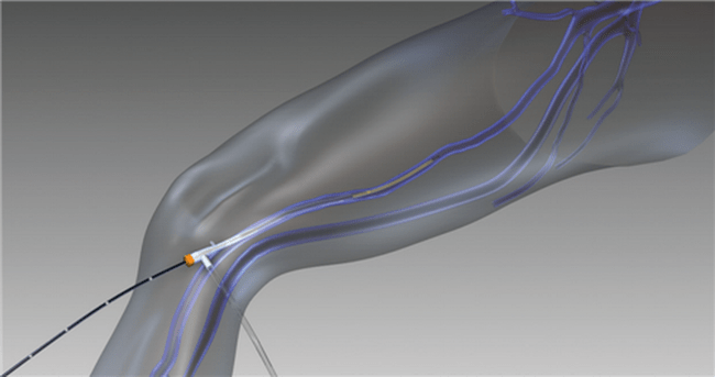 varisli damarlar için radyofrekans obliterasyonu